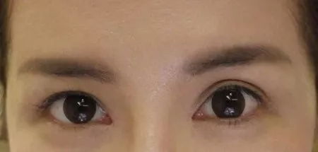 周深回应双眼皮贴被热掉了